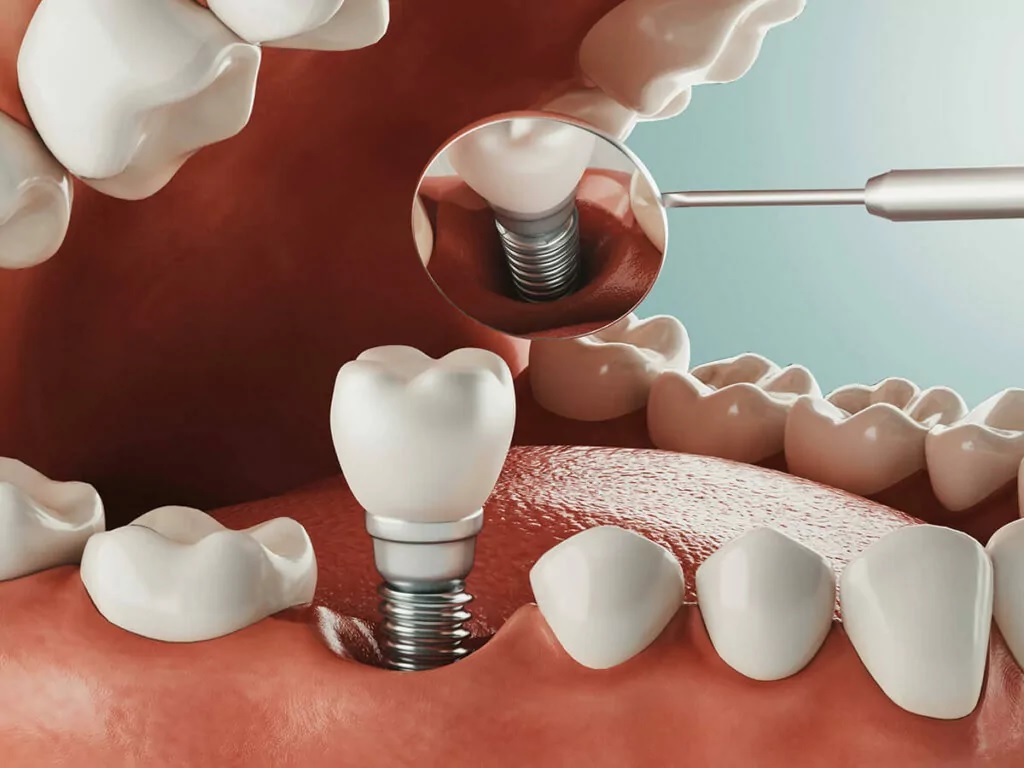 Understanding the Cost of Dental Implants at Cosmodontist Dental and Implant Centre in Gurgaon